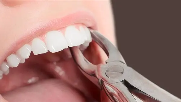 تفسير رؤية خلع الضرس في المنام